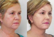 Что представляет собой ультразвуковой SMAS-лифтинг?