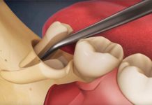 Какова цена на удаление зуба мудрости?