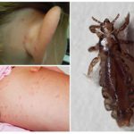 Симптомы и методы профилактики вшей и клопов