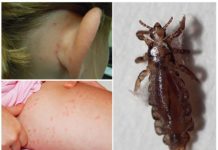 Симптомы и методы профилактики вшей и клопов