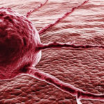 Рак легких можно определить по глазам — медики