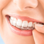 Производство и применение элайнеров