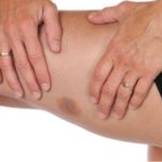 Синяки могут стать провесниками рака