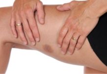 Синяки могут стать провесниками рака