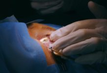 Когда проводят лазерную коррекцию зрения?