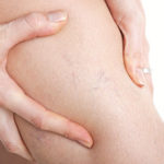 Судинні зірочки говорять про млявий кровоток і рубцювання печінки