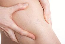 Небезпека судинних зірочок на ногах: міфи і реальність