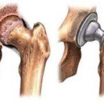 Методы эндопротезирования тазобедренного сустава