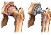 Методы эндопротезирования тазобедренного сустава