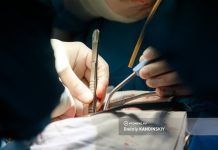 Около 20 камней вытащили врачи из желчного пузыря мужчины в томском селе. Орган удалили